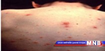 Цочмог, халууралт өвчний хам шинж тасралтгүй мэдээлэгджээ 