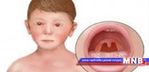 Улаан эсэргэнэ өвчнөөс сэргийлье
