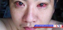 Нүдний хорт хавдар ухаалаг утаснаас үүдэлтэй