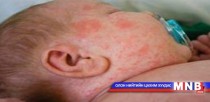 Улаанбурханаар өвдсөн хүүхдээ сахин хэвтэж буй ээжүүд өвдөх нь ихэсчээ 