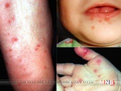 Гар, хөл, амны өвчний дэгдэлт нэмэгджээ