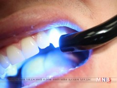 Шүдний уйланхай буюу шүдний киста гэж юу вэ 