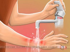 Түлэгдлийн үед үзүүлэх анхны тусламж