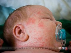 Экзем өвчтэй хүүхдийн хоолны дэглэм