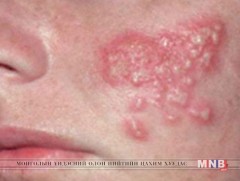 Энгийн герпес