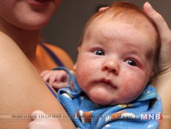 Диатез гэж юу вэ