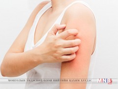 Харшил арьсны жижиг цочролоос эхлээд үхэлд хүргэх хэмжээний аюул учруулдаг