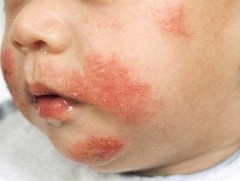 Бяцхан үрс нь харшилтай бол эцэг, эхчүүд юу анхаарах вэ 