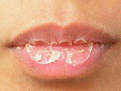 Уруул хуурайшиж, хагарвал хэрхэх вэ 