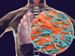 Өнөөдөр сүрьеэ өвчинтэй тэмцэх дэлхийн өдөр 