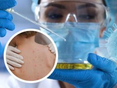 ДЭМБ: Сармагчны цэцэг өвчний халдвараас сэргийлж, сонор сэрэмжтэй байхыг уриалж байна