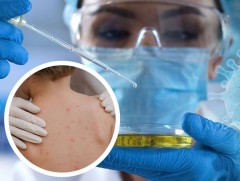 Сармагчны цэцэг өвчний халдвар Израиль, Швейцар, Австри улсуудад илэрлээ 