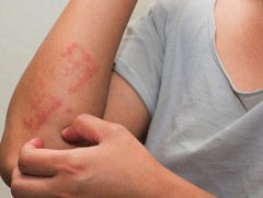 Хүнсний харшил амь насанд нөлөөлөх өндөр эрсдэлтэй