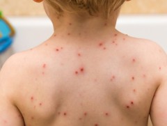 Салхинцэцэг өвчнөөс сэргийлье