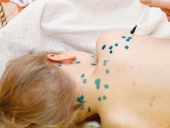 Салхин цэцэг өвчний дэгдэлт эхэлжээ