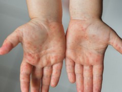 Улаанбурхан өвчний дэгдэлтэй байгаа улс оронд аялагчдад өгөх зөвлөмж