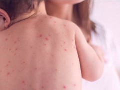 ХӨСҮТ: Улаанбурхан өвчний батлагдсан тохиолдол 141 болжээ   