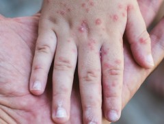 Улаанбурхан өвчний 55 тохиолдол бүртгэгдээд байна