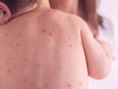 Улаанбурхан өвчин нууц хугацааны 3-5 хоногтоо вирус цусаар дамжина