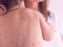 ХӨСҮТ: Улаанбурхан өвчний лабораториор батлагдсан тохиолдол 758 болжээ