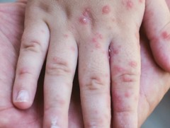 Улаанбурхан өвчний тохиолдол нэмэгдэх эрсдэлтэй байна
