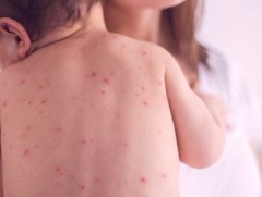 ХӨСҮТ: Улаанбурхан өвчний лабораториор батлагдсан тохиолдол 428 болжээ   