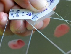 Сүүлийн таван жилийн хугацаанд хумхаа өвчний тохиолдол 4 дахин нэмэгдсэн байна