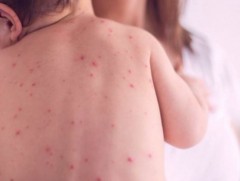 ХӨСҮТ: Улаанбурхан өвчний батлагдсан тохиолдол 220 болжээ