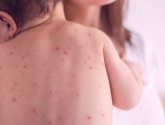 ХӨСҮТ: Улаанбурхан өвчний лабораториор батлагдсан тохиолдол 800 болжээ
