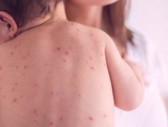 Улаанбурхан өвчний батлагдсан тохиолдол 552 болжээ