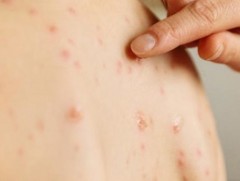 ХӨСҮТ: Улаанбурхан өвчний 617 тохиолдол бүртгэгдлээ