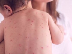 Улаанбурхан өвчний вакцинд хамрагдаагүй болон хэт бага насны хүүхдээ гадуур авч явахгүй байхыг зөв..