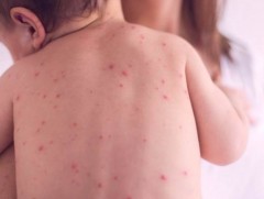 ХӨСҮТ: Улаанбурхан өвчний батлагдсан тохиолдол 15 нэмэгджээ