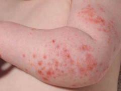 ХӨСҮТ: Монгол Улсын хэмжээнд менингококкт халдварын батлагдсан 7 тохиолдол  бүртгэгджээ   