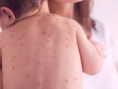 ХӨСҮТ: Улаанбурхан өвчний батлагдсан тохиолдол 4 нэмэгджээ