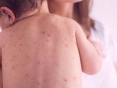 ХӨСҮТ: Улаанбурхан өвчний халдвар буурчээ   